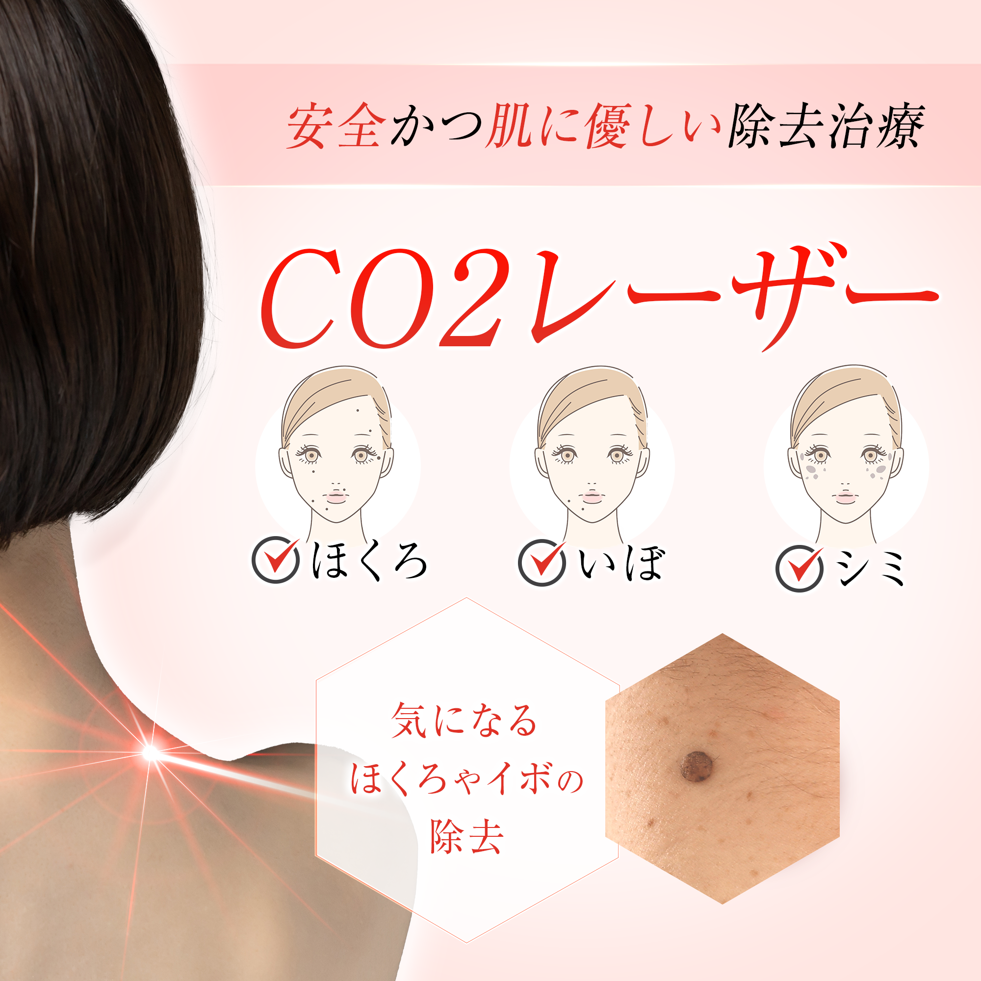 CO2レーザー