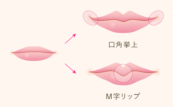 口角挙上（スマイルリップ）・M字リップ