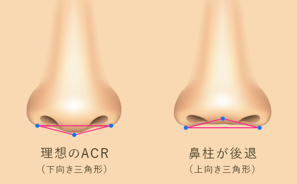 耳介軟骨鼻先移植、鼻翼挙上の整形